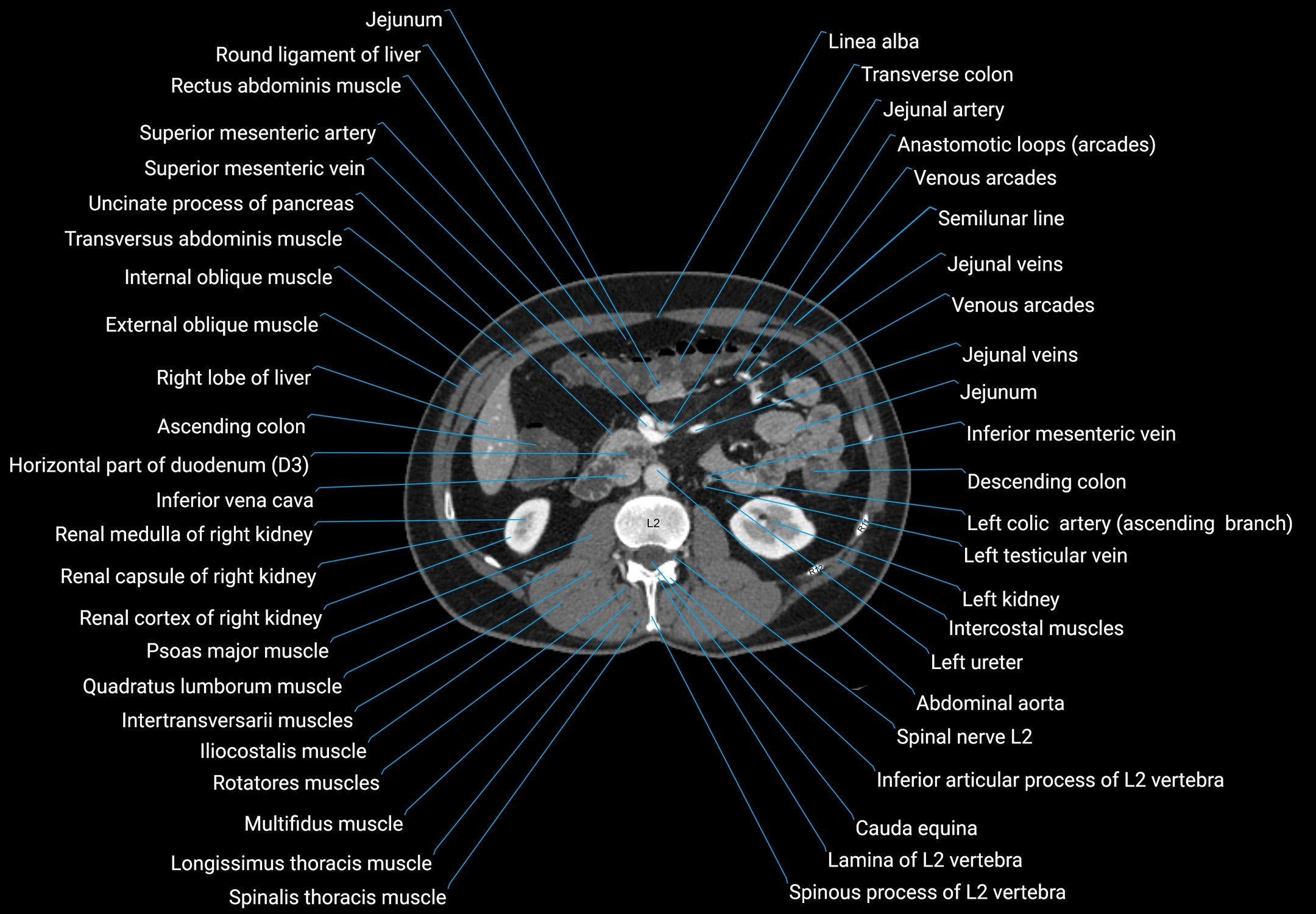 CT male pelvis axial cross sectional anatomy labelled radiology image -00078.webp